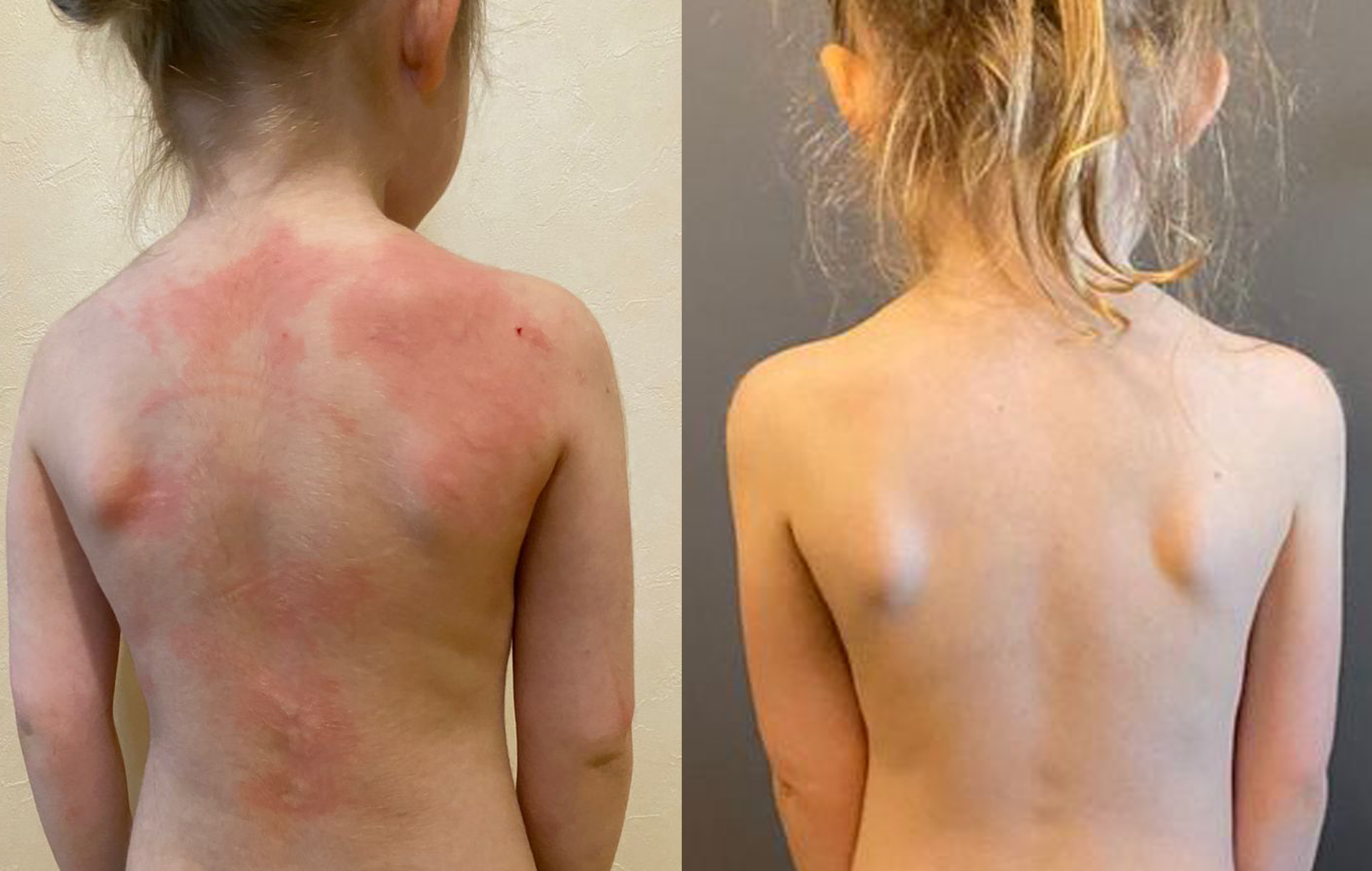 Состояние кожи до и после введения препарата